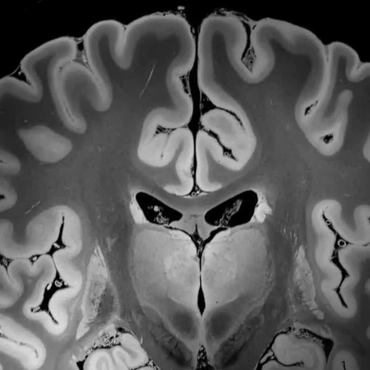 Ressonância magnética do encéfalo em corte coronal, com os ventrículos e os núcleos da base visíveis